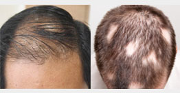 Hair Fall & Alopecia
